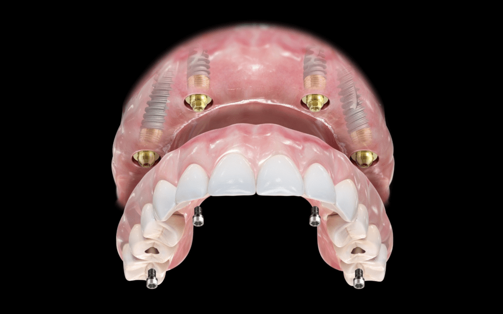 Teljes fogsor implantátummal