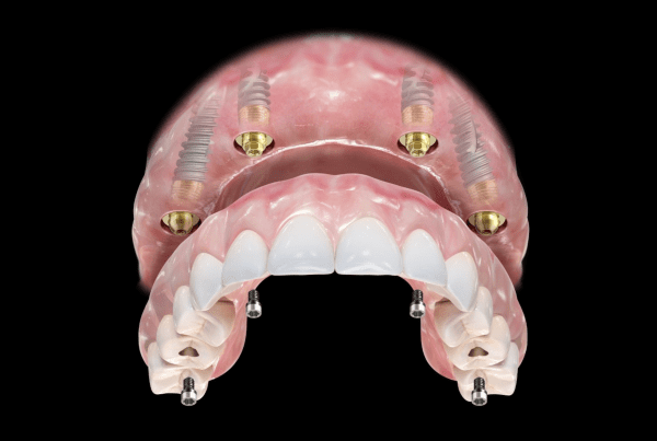 Teljes fogsor implantátummal